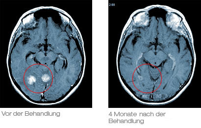 Radiochirurgische Behandlung Hirnmetastasen